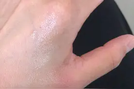 开水烫伤正确的处理方法。不起泡，不红肿。看到请收藏图片