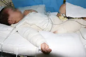 2岁女童无意间打翻开水全身被烫伤，母亲欲割皮救女反被孩子安慰：妈妈不哭图片