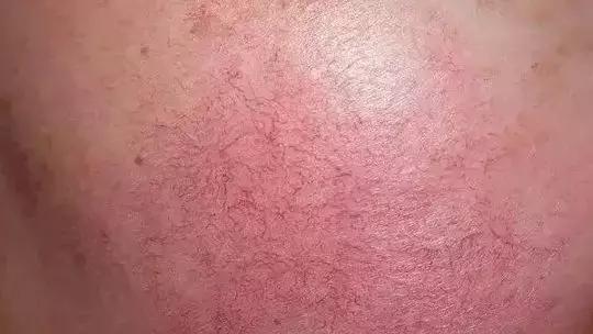 红血丝皮肤的保养 红血丝皮肤如何保养 红血丝皮肤的保养 红血丝皮肤如何保养