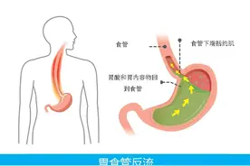 胃食管反流的解决思路图片