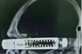 12厘米长的汽车配件飞弹而出，从右眼直插入脑，33岁修车工奇迹生还……图片