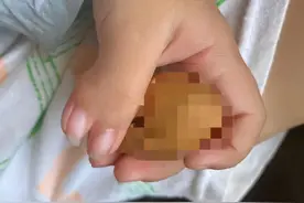 18岁女孩手指长得像螃蟹钳子！专家建议：先天性手部畸形早做矫形手术图片