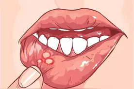 令人头痛的口腔溃疡，其实有很多方法可以缓解，听听牙医的建议图片