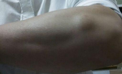 身上长得脂肪瘤有什么危害，如何判断脂肪瘤是良性还是恶性