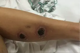 老烟民请注意！大动脉阻塞，双腿糜烂都可能被你抽出来图片