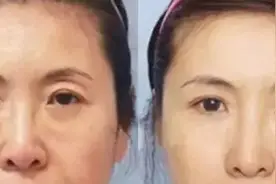 三角眼的矫正方法图片