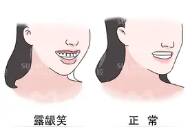 牙齿矫正案例分享：骨性I类开颌矫治，有图有真相图片