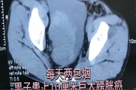 每天2包烟，男子患上10厘米巨大膀胱癌图片