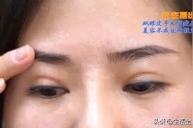 女子双眼皮手术留疤痕要求院方退钱 医院：没有退费这一说图片