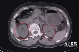 吃了一盘家常菜，女子三天不排尿，还患上尿毒症图片