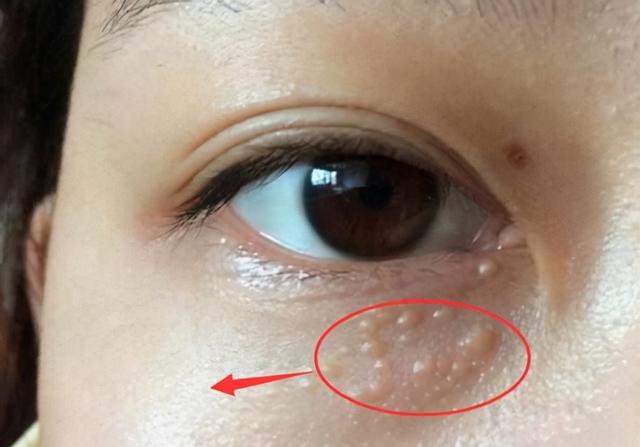 眼部周围有脂肪粒怎么去除（脸上长脂肪粒怎么办脸上长脂肪粒怎么去除小窍门）