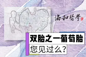 极为罕见！怀了双胞胎，却有一个是葡萄胎？高龄宝妈葡萄胎16周成功引产于阴道分娩图片