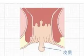 你身上有这样的小肉揪吗？哪些是癌变信号？哪些是病毒入体？图片