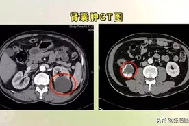 辟谣：有些食物，吃了可以让囊肿越来越小？图片