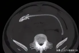 突发！长约40公分黄鳝从男子肛门钻进肚子图片