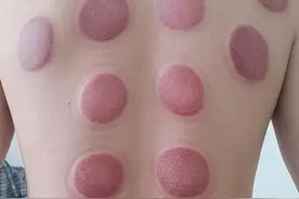 拔火罐有什么效果图片