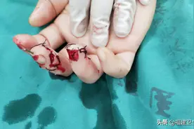 切菜机误切，厦门女子3个手指被切中！成功“还原”后医生提醒图片