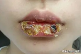 健康之口炎图片