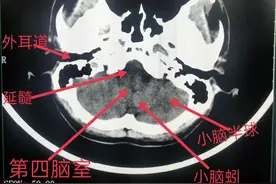 学习《CT读片指南》——头颅CT(2)图片