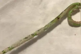 这根脏脏的管子上面，是我怀孕期间积累的结石图片