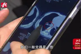 家长注意！男童持续咳嗽发烧一个月不见好，竟是鸡爪卡气管了视频封面