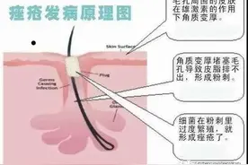 【“痘”不再怕】从病理上讲讲脸上的痘痘图片