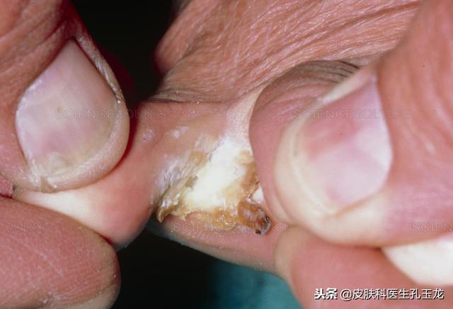 脚真菌感染角化