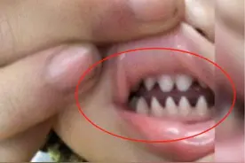 宝宝长了一嘴“鲨鱼牙”，妈妈实在无法忍受求助医生，医生：晚了图片