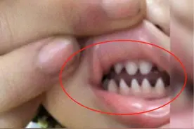 宝宝长了一嘴“鲨鱼牙”，妈妈实在无法忍受求助医生，医生：晚了图片