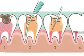 牙齿根管治疗后，长期不戴牙套可以吗？NO,牙齿裂开的风险较大图片