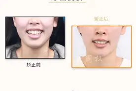长沙牙齿矫正｜正畸合集：牙齿拥挤、龅牙、地包天、深覆合图片