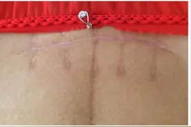 剖腹产要挨几刀？缝多少层肚皮？我经历了剖腹产却不知道！图片