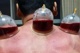 拔火罐时，吸出的瘀血就是体内的毒素？大夫说出大实话图片