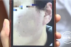 长时间戴口罩上班，长痘怎么办？一个小窍门避免捂出“口罩痘”图片