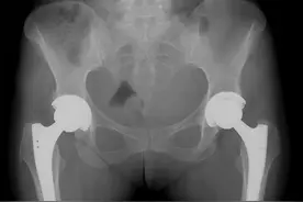 股骨头坏死的诊断与治疗图片