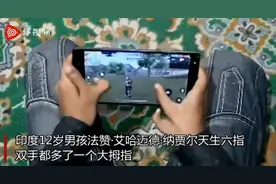 印度12岁男孩天生双手“六指”，自称有助于赢得电子游戏和板球图片