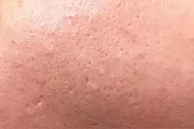 青春走了，青春痘留下的的痘坑痘印咋办？图片