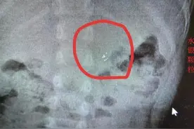 4岁男孩误吞水银，奶奶坚持让娃吃了韭菜再送医，医生：太高明了图片