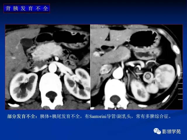 胰腺的解剖与常见变异