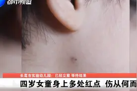 河南许昌 女童称被幼儿园老师用笔扎 涉事老师否认 警方已立案图片