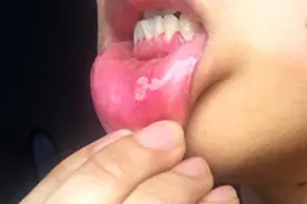 口腔溃疡，反复来找麻烦是什么原因？图片