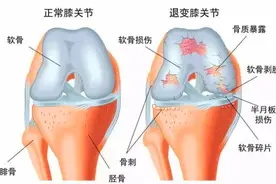 膝关节有"弹响"怎么办？治疗还是放任不管？医生给你说清楚图片