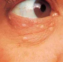 皮肤晒伤后像鸡皮多年