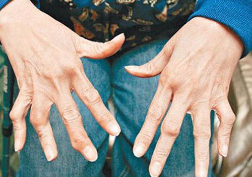类风湿关节炎有哪些症状表现?这六大症状最为多见