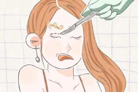 双眼皮术后肿胀期是多久，怎么判断双眼皮有没有割宽？图片