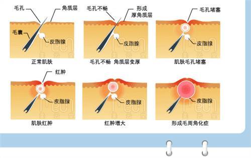 民间治疗毛孔角化症