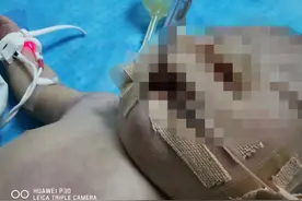 新生儿“肺出血”命悬一线 惊心动魄24小时图片