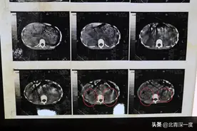 消失的左肾：答案在我身上，开腹验肾是唯一的选择图片