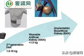最全汇总！各类人工肾，临床应用要多久？图片