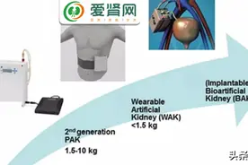 最全汇总！各类人工肾，临床应用要多久？图片
